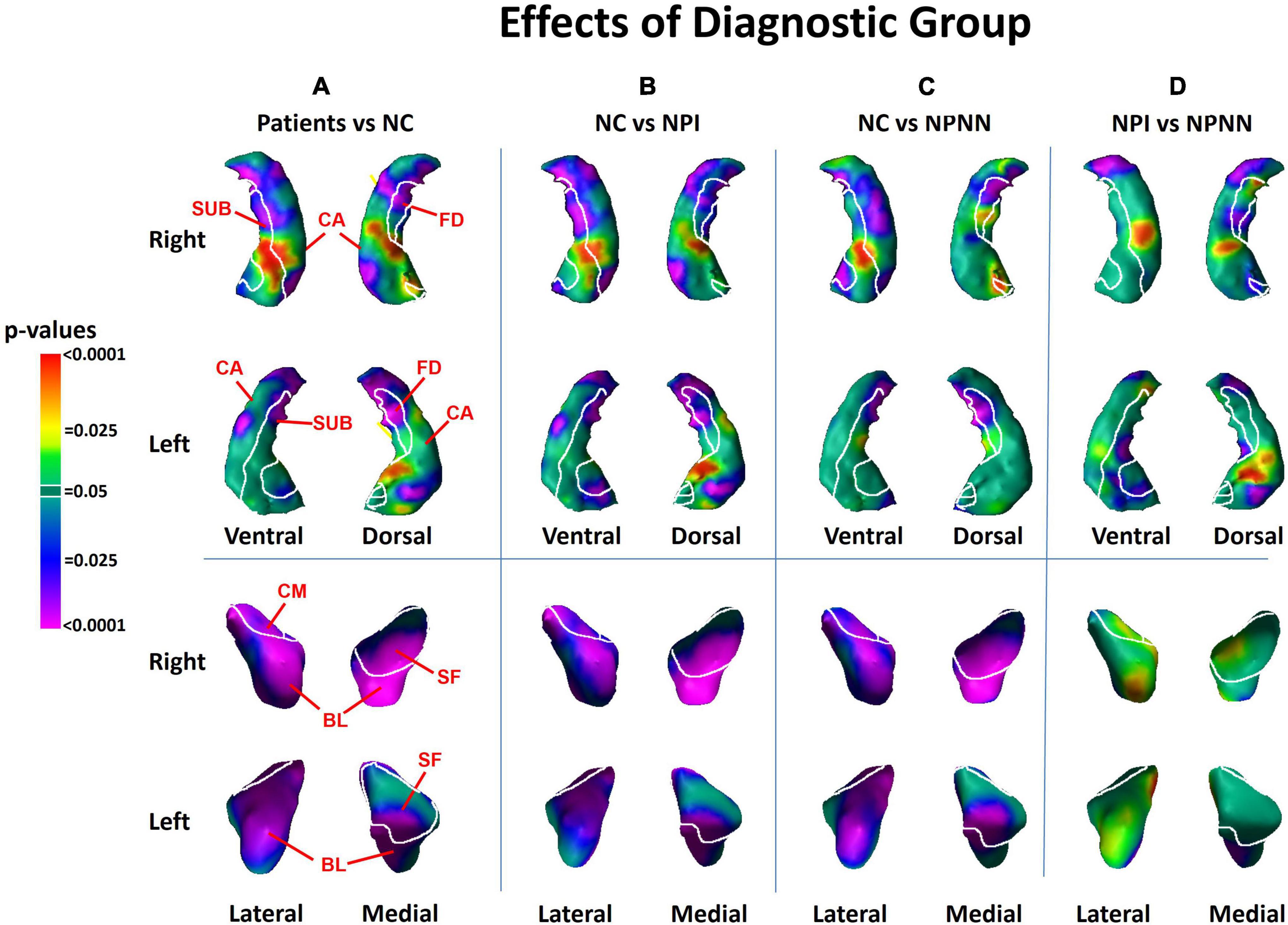 Aberrant hippocampus and amygdala morphology associated with cognitive deficits in schizophrenia